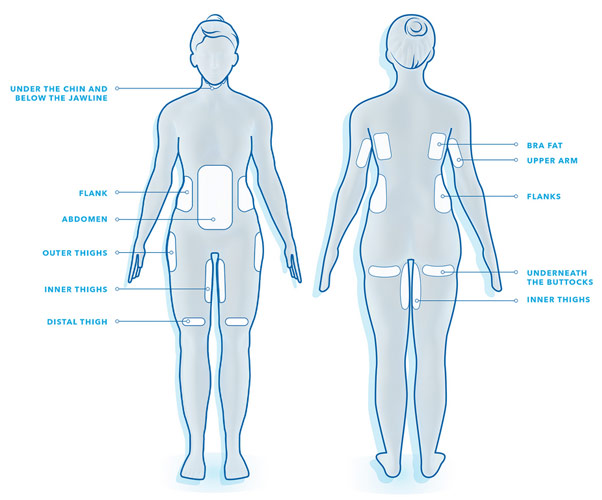 CoolSculpting treatment areas diagram