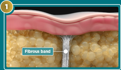 Diagram showing fibrous band beneath skin