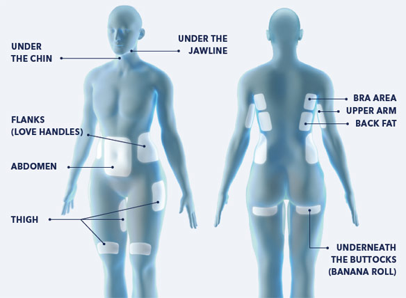 Diagram showing Coolsculpting treatment areas