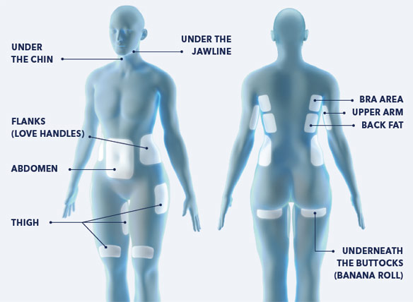 Diagram - CoolSculpting's 9 treatment areas