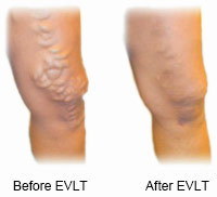 Leg before and after EVLT