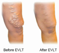 Legs before and after EVLT